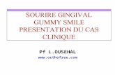 Sourire gingival