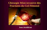 Chirurgie Mini-invasive des Fractures du Col Fémoral Jean Avédikian.