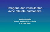 Imagerie des vascularites avec atteinte pulmonaire Mathieu Lederlin Service d’Imagerie Thoracique CHU Bordeaux.
