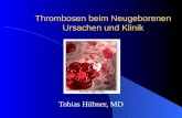 Thrombosen beim Neugeborenen Ursachen und Klinik Tobias Hübner, MD .