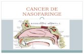 Cancer de Nasofaringe Crispi Nuevo