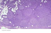 Linfoma nodulare. Tumore benigno Tumore maligno Anaplasia assente: presente: simile al tessuto perdita del di origine differenziamento Velocit.
