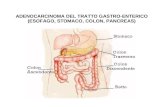 ADENOCARCINOMA DEL TRATTO GASTRO-ENTERICO (ESOFAGO, STOMACO, COLON, PANCREAS)
