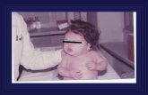 Segni e sintomi precoci di Ipotiroidismo congenito Ritardata emissione del meconio e/o stipsi Ittero neonatale protratto Distensione addominale e/o.