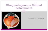 Rhegmatogenous retinal detachment