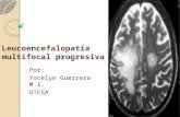 Leucoencefalopatía multifocal progresiva