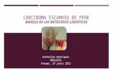 Metastasis linfatica en carcinoma escamoso de pene