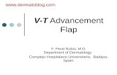 V-T advancement flap.