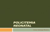 Policitemia Neonatal