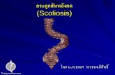 กระดูกสันหลังคด (Scoliosis)