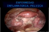 5.-ENFERMEDAD INFLAMATORIA PELVICA