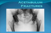 Acetabulum fractures