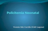Policitemia neonatal