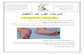 تشوهات القدم عند الاطفال - البروفيسور فريح ابوحسان - استشاري العظام في الاردن