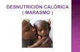 desnutricion calorica