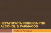 Hepatopatía inducida por alcohol & fármacos