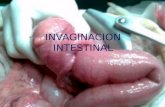 Invaginacion Intestinal