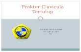 Gerry Fraktur Clavicula Dextra PPT Blok 14
