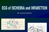 ECG, Ischemia,MCI