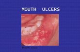 Mouth Ulcer Ok