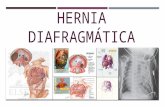 Hernia diafragmática