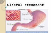Ulcerul stenozant