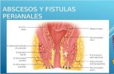 Abscesos abscesos Y FÍSTULAS PERIANALESy Fistulas Perianales