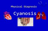 Physical Diagnosis Cyanosis. Definition Cyanosis refers to a bluish( 带蓝色的； 带青色的 )color of the skin and mucous membranes resulting from an increased quantity.