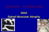 Hypotonia - the floppy baby SMA Spinal Muscular Atrophy.
