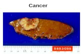 Cancer. Science 332(24), p1519, 2011 Cancer (1) Non-alcoholic fatty liver to HCC; (2) HCV HCC (3) HBV HCC 脂肪肝會增加罹患肝癌的危險達 2.5 至 3 倍.
