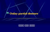 Onlay partial denture 嘉泉醫大 吉病院 齒科센터. http:dent.ghil.com/ Anterior teeth – attrition Vertical dimension – decrease RPD - abrasion.
