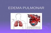 EDEMA PULMONAR.  Acumulación de líquido en el intersticio pulmonar, en los alvéolos, en los bronquios y bronquiolos; resulta de la excesiva circulación.