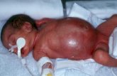 נולד תינוק זכר ב- 500 גרם בשבוע 27 להריון.