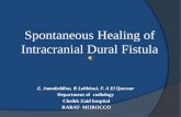 Spontaneous Healing of Intracranial Dural Fistula