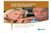 Cancer de la peau non melanome