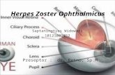 CSS - Herpes Zoster Ophthalmicus (Tyas)
