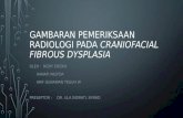 Presentasi Fibrous Dysplasia