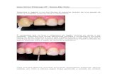 Caso Clínico - Clareamento Em Dente Não Vital