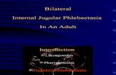 Bilateral Phlebectasia