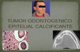 TOEC - Tumor Odontogenico Epitelial Calcificante