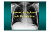 Aspects radiologiques de la TB Thoracique - nodule infiltrant