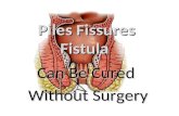 Piles fissures fistula