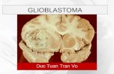 Chẩn đoán hình ảnh Glioblastoma (GBM)