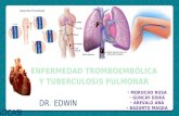 Tromboembolia pulmonar y tuberculosis pulmonar