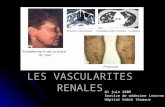 Renal vasculitis