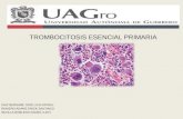Trombocitosis esencial - primaria