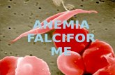 anemia falciforme o drepanocítica