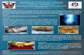 GANGRENA DE FOURNIER CON EXTENSION … poster 4 de 8.pdf · INTRODUCCION: La Gangrena de Fournier es una fascitis necrotizante de periné y genitales, causada por una mezcla de bacterias,