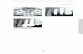 OSSTEM IMPLANT SYSTEM abutment was fastened and suture was not practiced. ... OSSTEM IMPLANT SYSTEM 10. LAS KIT Fig. 7. Bone core was detached …