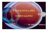 PATOLOGIA DEL CRISTALINO - Facultad de Medicina. • Toda opacidad del cristalino o de su cápsula,sintener en cuenta su tamaño,localización o forma,lallamamos catarata congénita